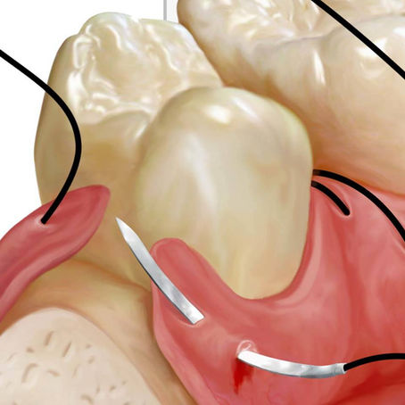 Oral Cerrahide Kullanılan Dental Sütür Teknikleri ve Malzemeleri