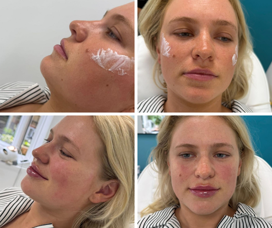 Dermal Fillers