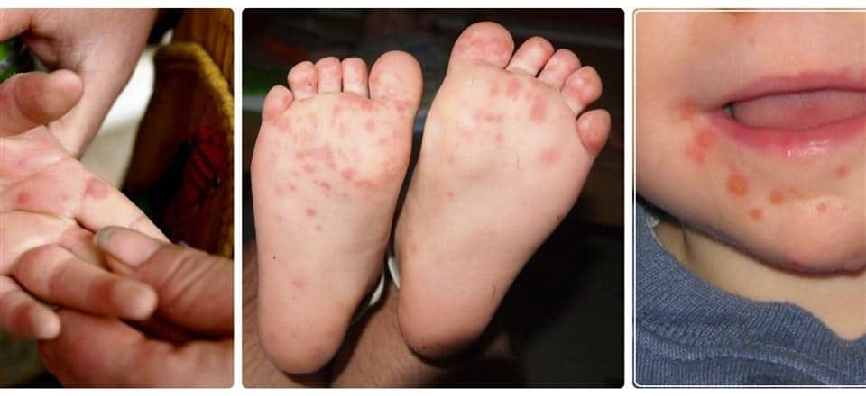 Close-up of a child's rash on hand, feet, and mouth. Red spots on skin. Indoor lighting. Image series showing medical symptoms.
