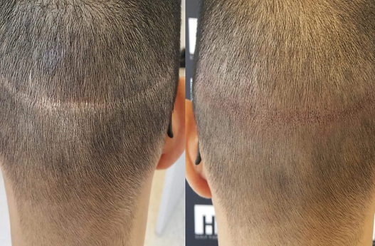 Natural hairline restoration with scalp micropigmentation in Milwaukee area