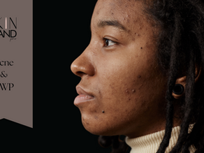 Acne & Nano Infusion: When Is the Right Time?