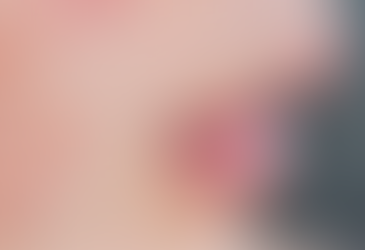 Embracing the Purge: The Transformative Journey to Clearer Skin