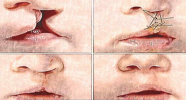 구순구개열어린이들