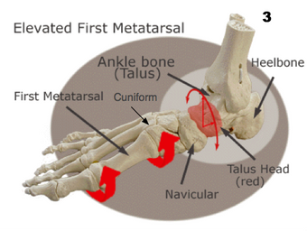 Elevated first metarsal הגורם לקריסת יתר