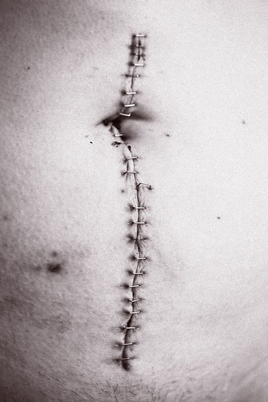 cicatrice verticale sur un nombril et un ventre