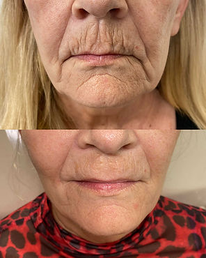 results of acne facials, from red, bumpy, painful acne to clear, smooth, bright skin