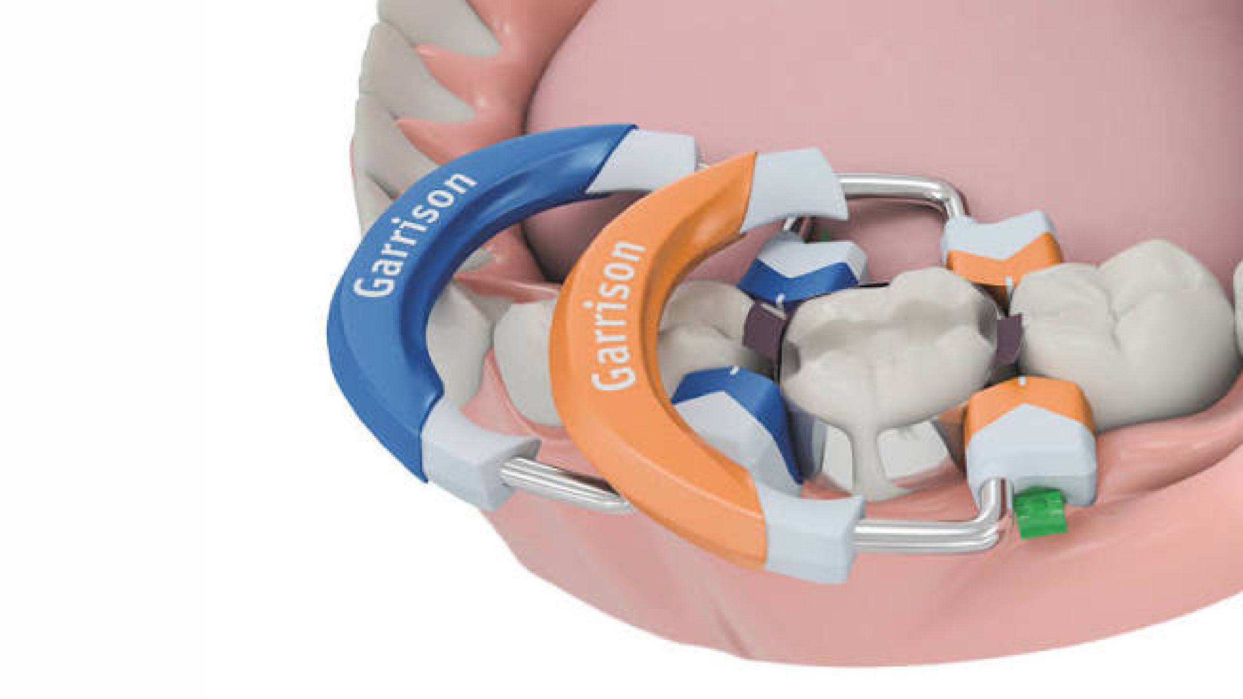 Garrison Composi-Tight 3D Fusion sectional matrix system for Class II restorations