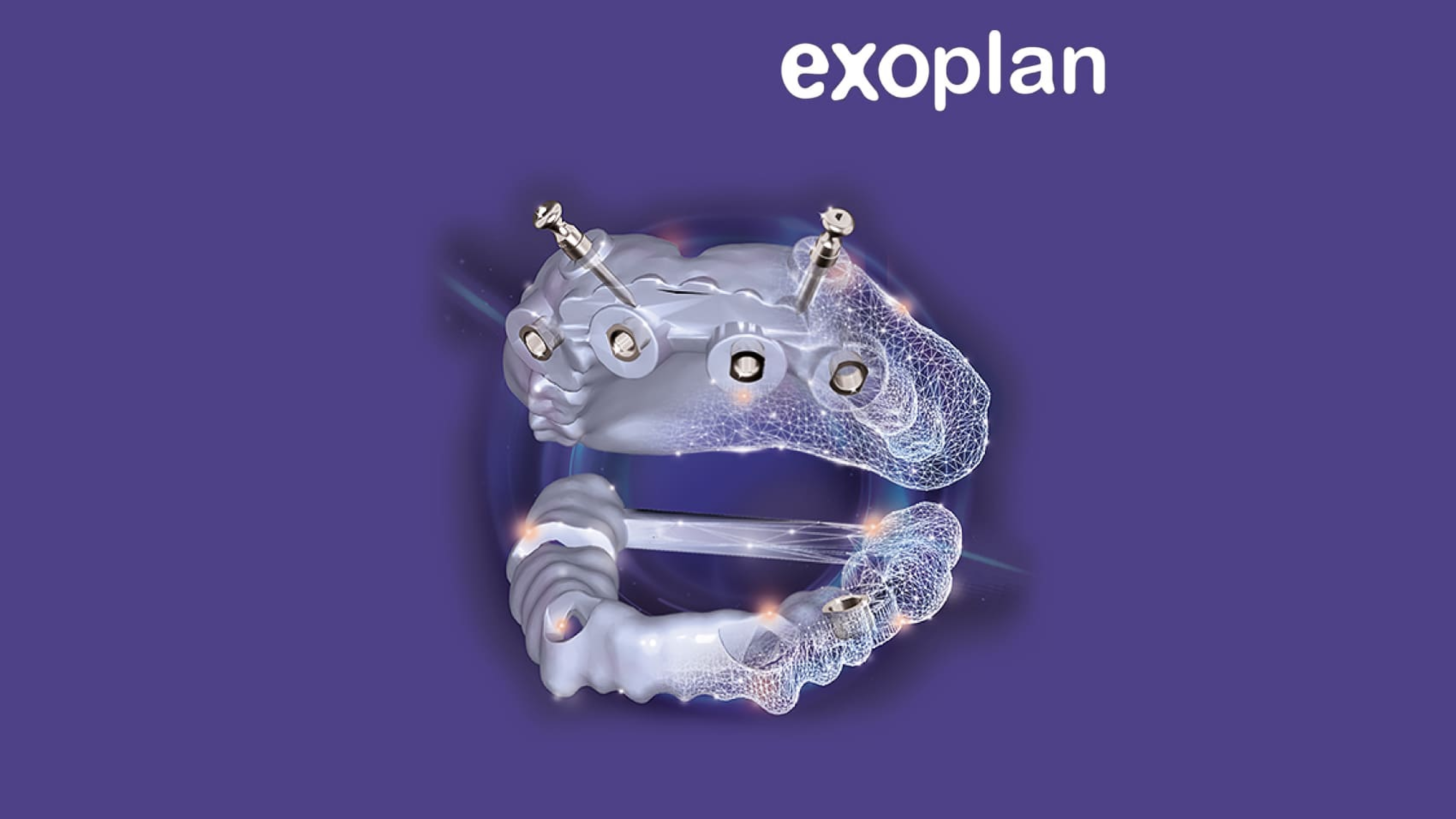 exocad Exoplan implant and surgical planning software for guided dental implant workflows