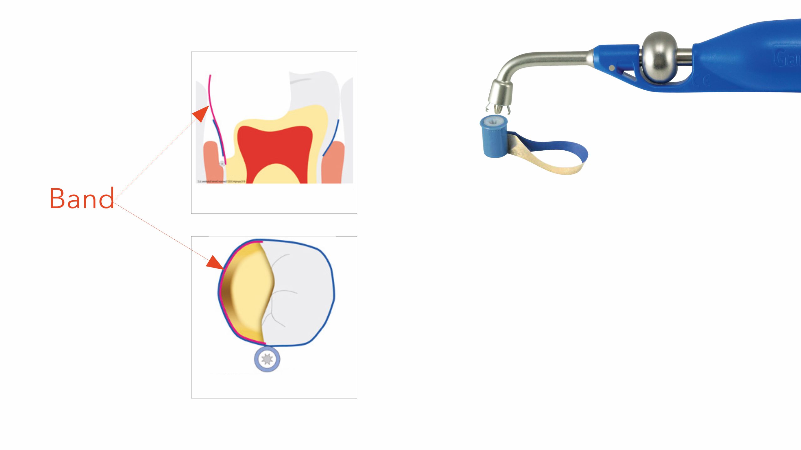 Garrison Deep Margin Elevation Kit for subgingival dental restorations
