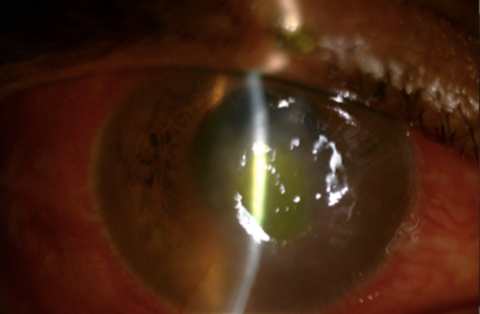 corneal ulcer, infection, keratitis, microbial,bacterial, fungal