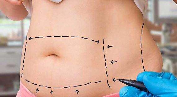 Tummy Tuck Site.jpg
