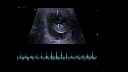 first tri heartbeat  video and sound