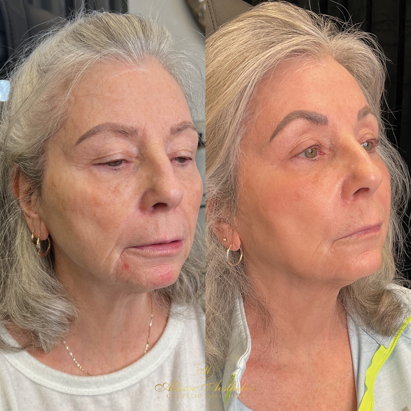 Lumecca Treatment Alison Aesthetics Cosmetic Injections Corning NY