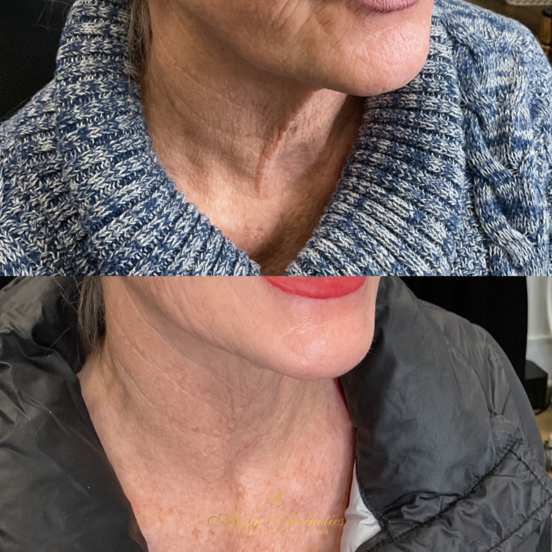 Morpheus8 Treatment Alison Aesthetics Cosmetic Injections Corning NY