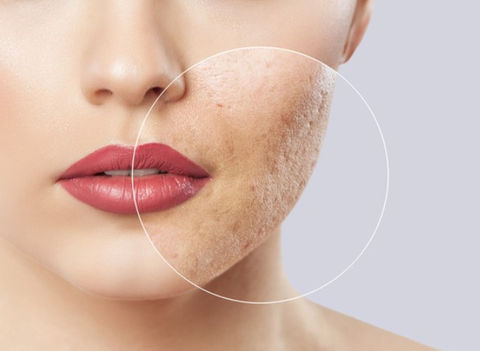 Acne Scarring - Picoway Rresolve.jpg