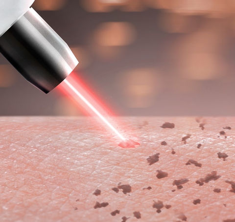 Age Spot Removal.jpg