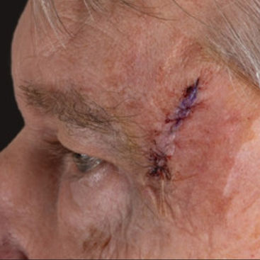 Close-up Mohs Surgical Incision Face.jpg