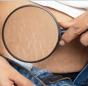 Stretch Mark Through Magnifying Glass Beneath a Womens Jeans.jpg