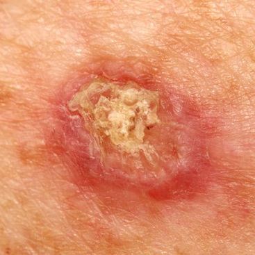 Squamous Cell Carcinoma.jpg