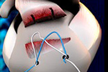 Rotator cuff tendon re-tear after surgery.png