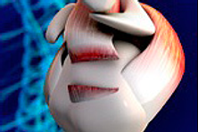 Rotator cuff tendon tear.png