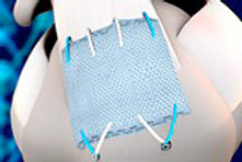 Rotator cuff tendon surgical repair using Ratcliffe BioMimic.png