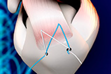 Rotator cuff tendon surgical repair.png