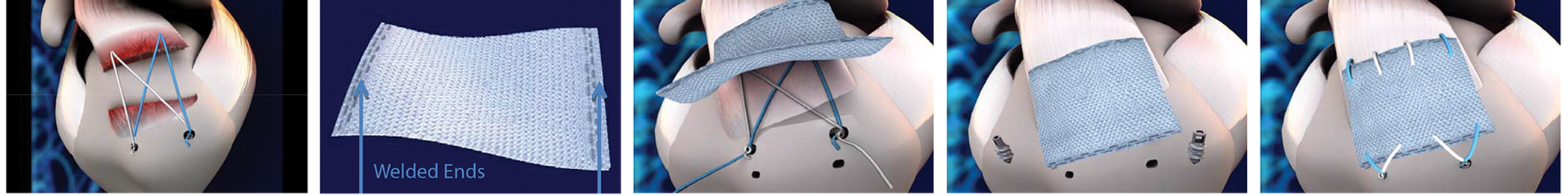 Repair Augmentation.png