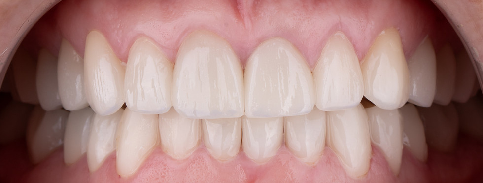 After photo of zirconia crowns smile restoration