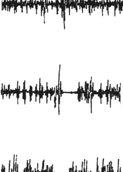 Distonia-mioclonia (DYT11, DYT-SGCE)