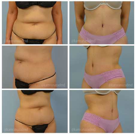 3 MONTHS POST TUMMY TUCK SURGERY
