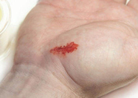 HERIDAS: he aquí los alimentos que ayudan a la piel a curarse rápidamente