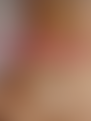 5 dicas sobre o adesivo transdérmico anticoncepcional