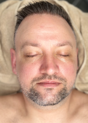 After Hydor facial to treat congested, dull aging skin