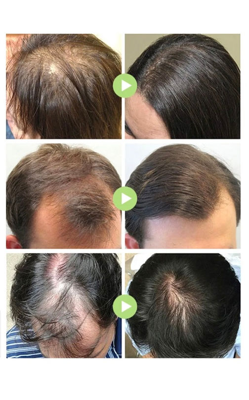 縮圖：Rosemary and Batana-Blend Hair Growth Oil