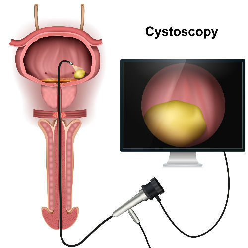 ציסטוסקופיה