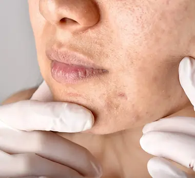 melasma-causas-e-tratamentos.webp