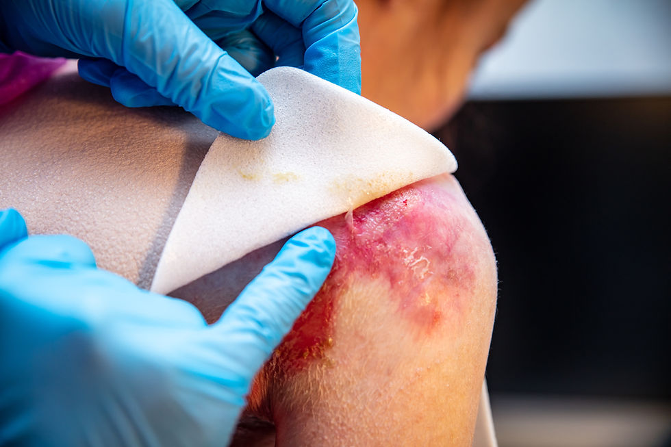 Burn Wound on patient