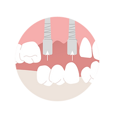 Zahnimplantate_Illus_Clinius_Zeichenfläche 1 Kopie 2.png