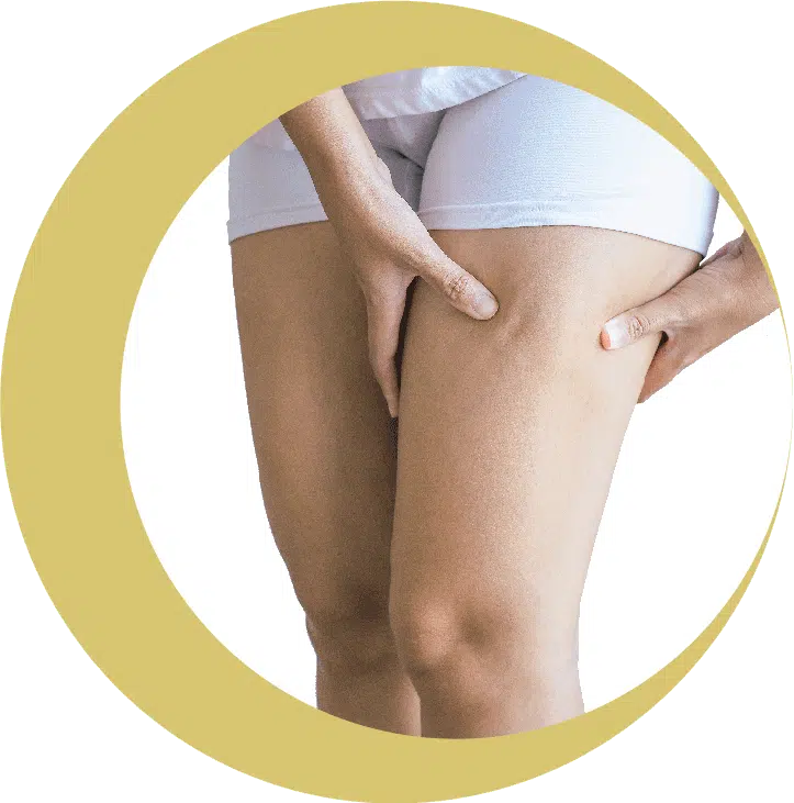 celulitis-onnafit-min.png.webp
