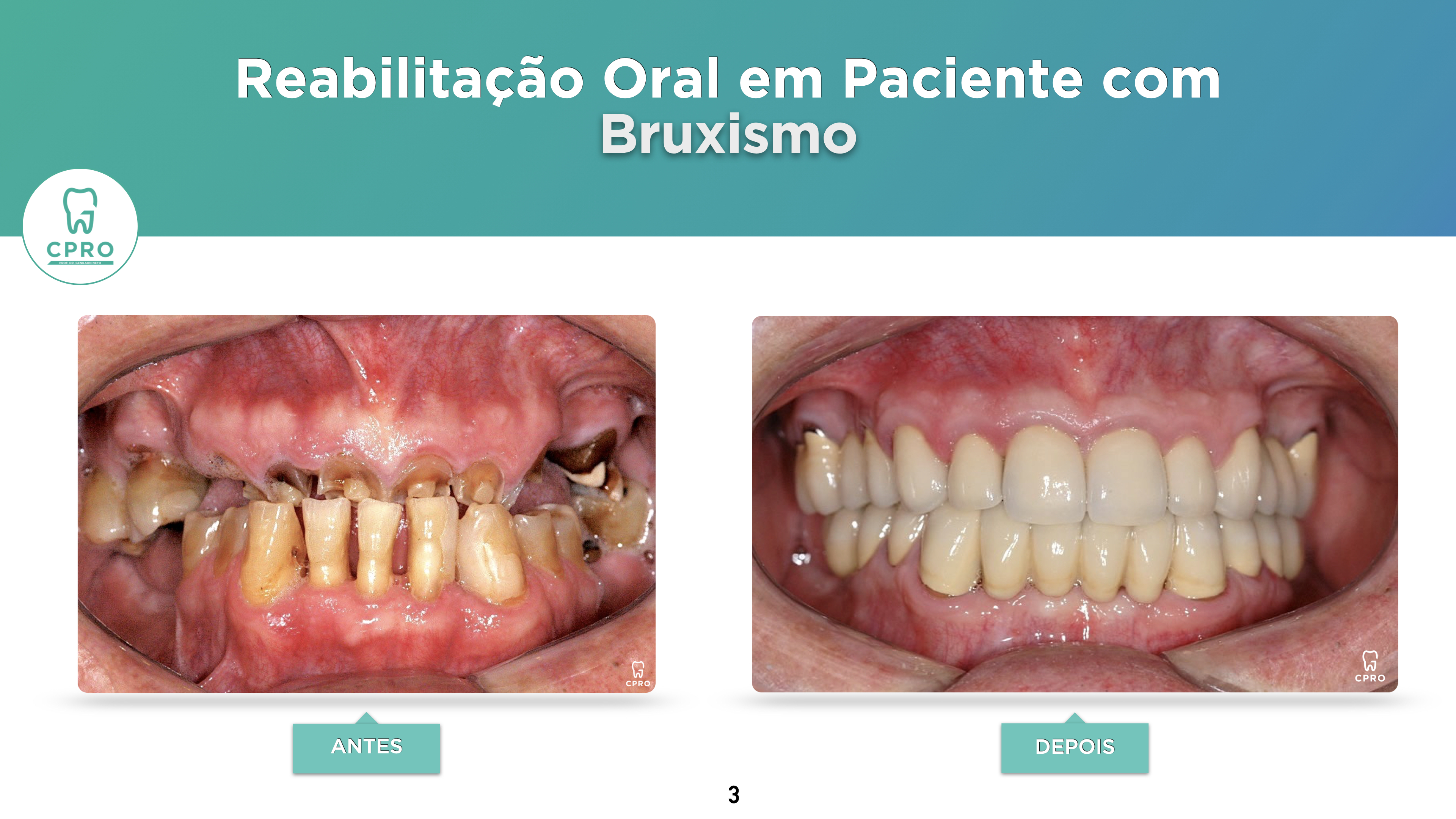 Prótese Dentária