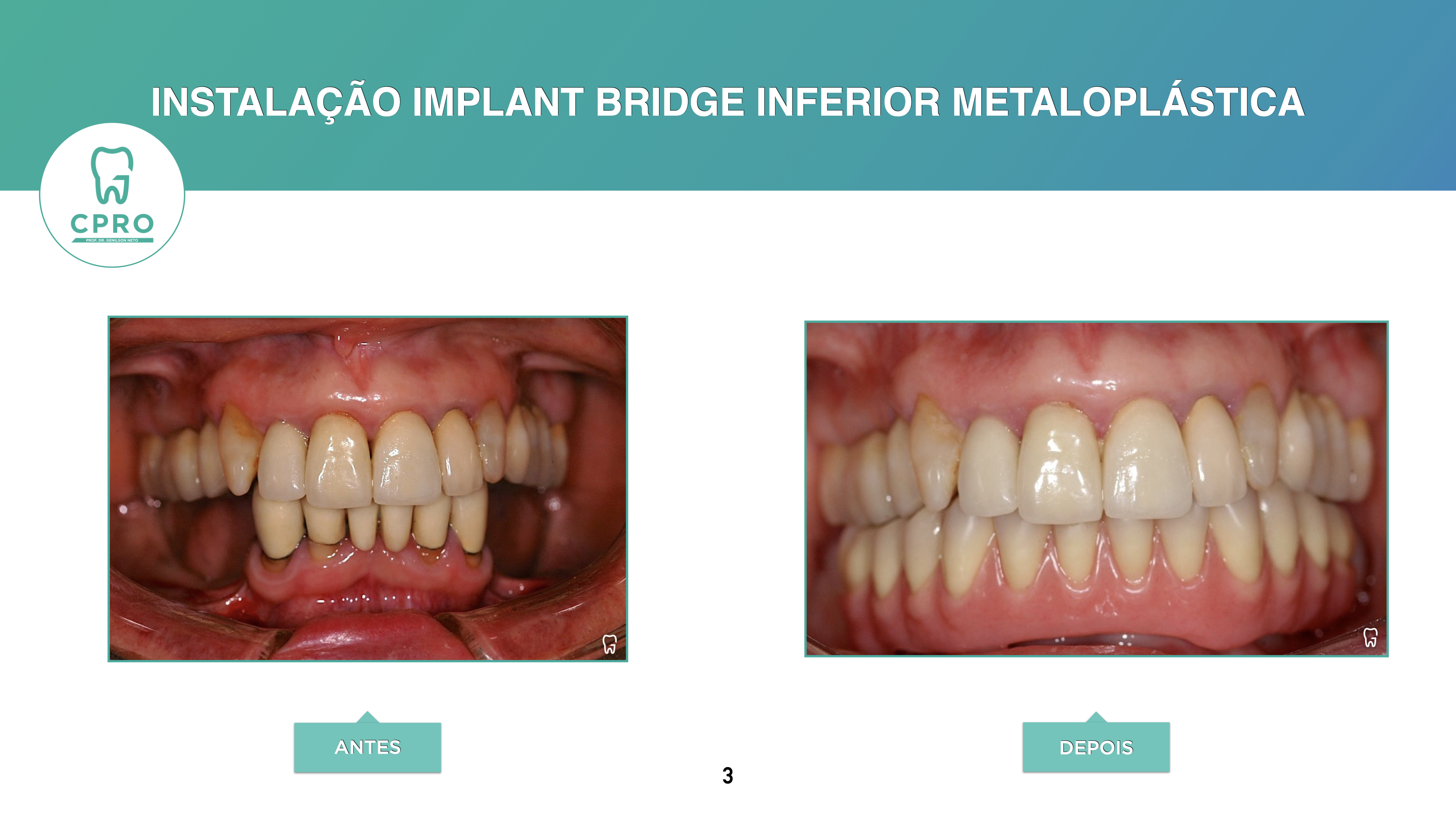 Implantes Dentários