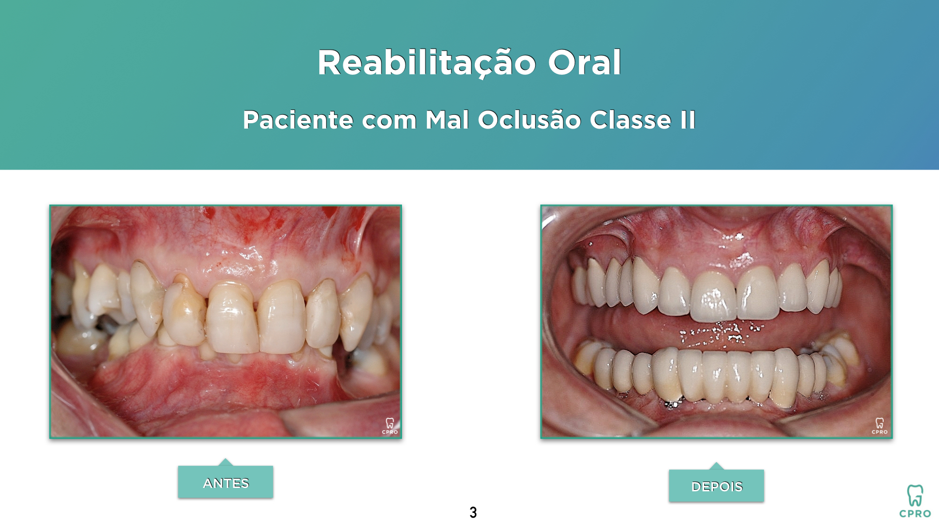 Oclusão | Implantes | Prótese Fixa