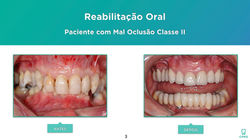 Oclusão | Implantes | Prótese Fixa
