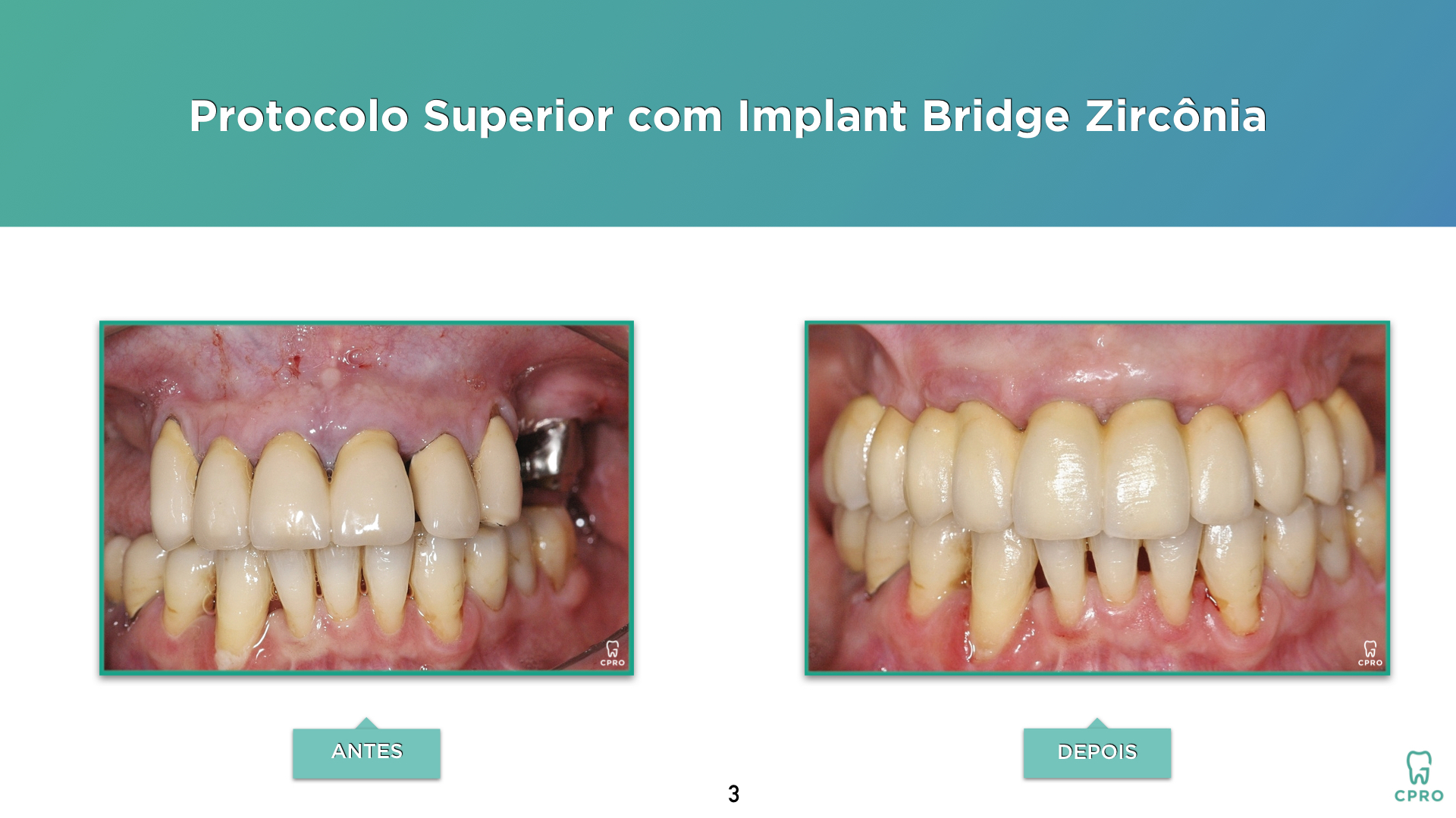 Implantes