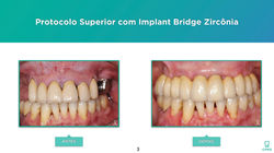 Implantes