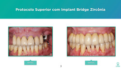 Implantes