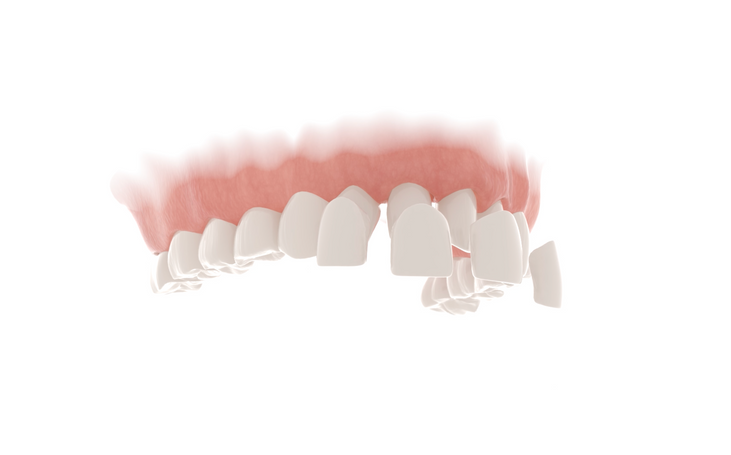 Dental Veneers / Clínica Dental CPRO / CPRO Dental Clinic