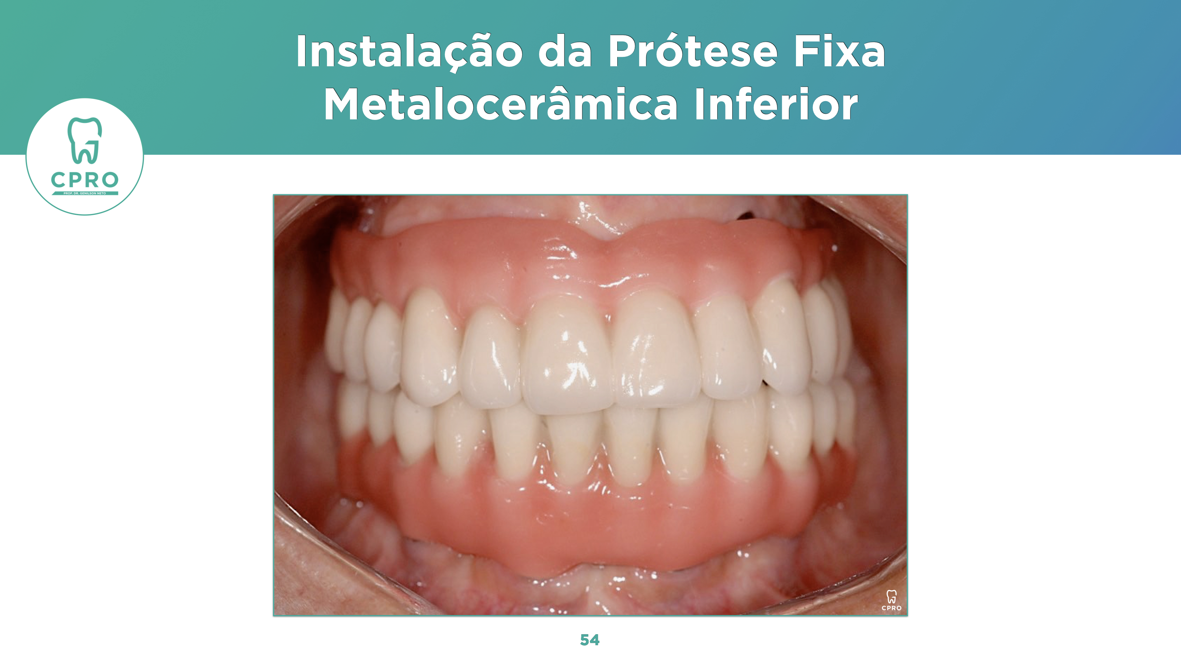 Implantes Dentários