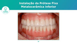 Implantes Dentários